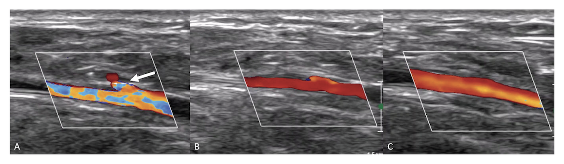 Figure 4. (A) Extravascular ultrasound (EVUS) assessment of the tibial artery after sheath removal