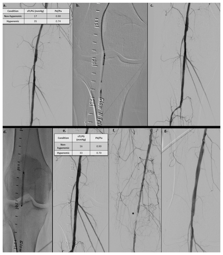 Prasad Figure 3. Patient with diabetes and Rutherford grade 3 claudication presented with an eccentric popliteal lesion.