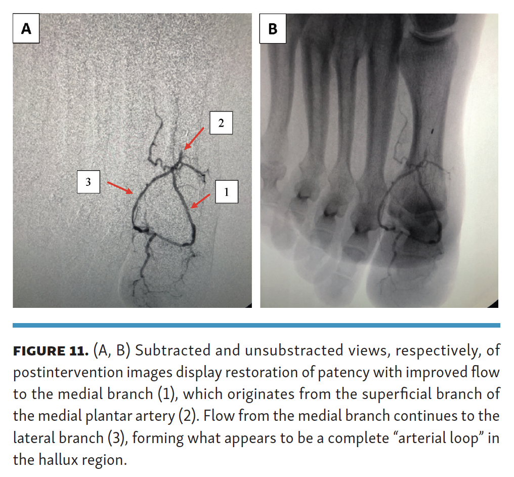 Pyon Impact of Performing  Lower-Extremity Angiographic Intervention Beyond the Pedal Plantar Loop FIg 11