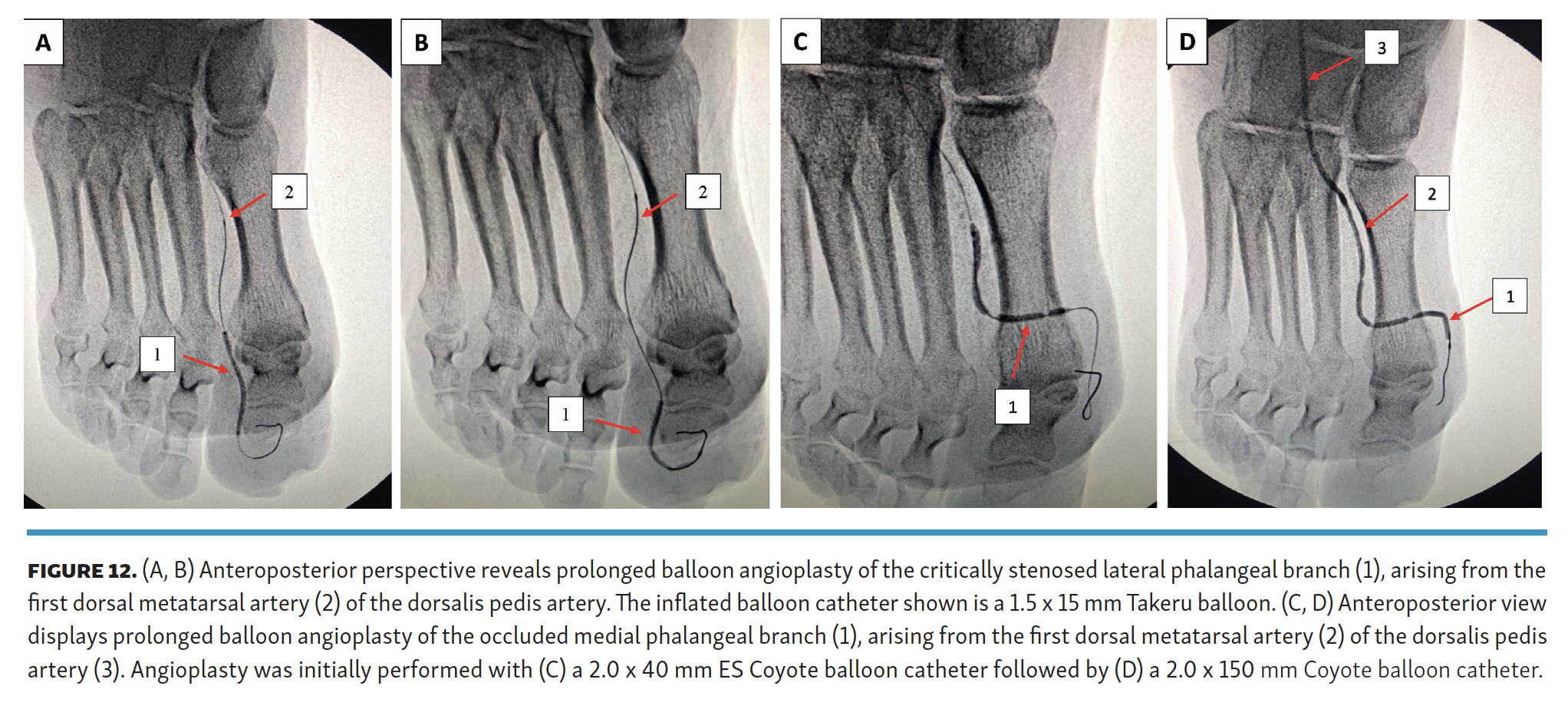 Pyon Impact of Performing  Lower-Extremity Angiographic Intervention Beyond the Pedal Plantar Loop FIg 12