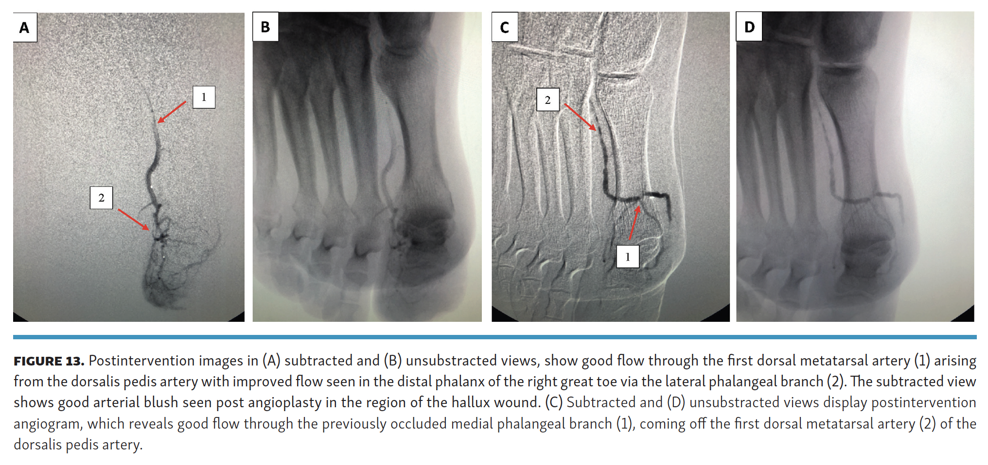 Pyon Impact of Performing  Lower-Extremity Angiographic Intervention Beyond the Pedal Plantar Loop FIg 13